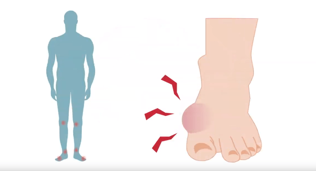 articulațiile picioarelor doară periodic dureri la nivelul articulațiilor degetului ce trebuie făcut
