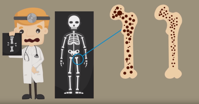 Qué Es La Osteoporosis Qué Es Síntomas Diagnóstico Y Tratamiento 5228