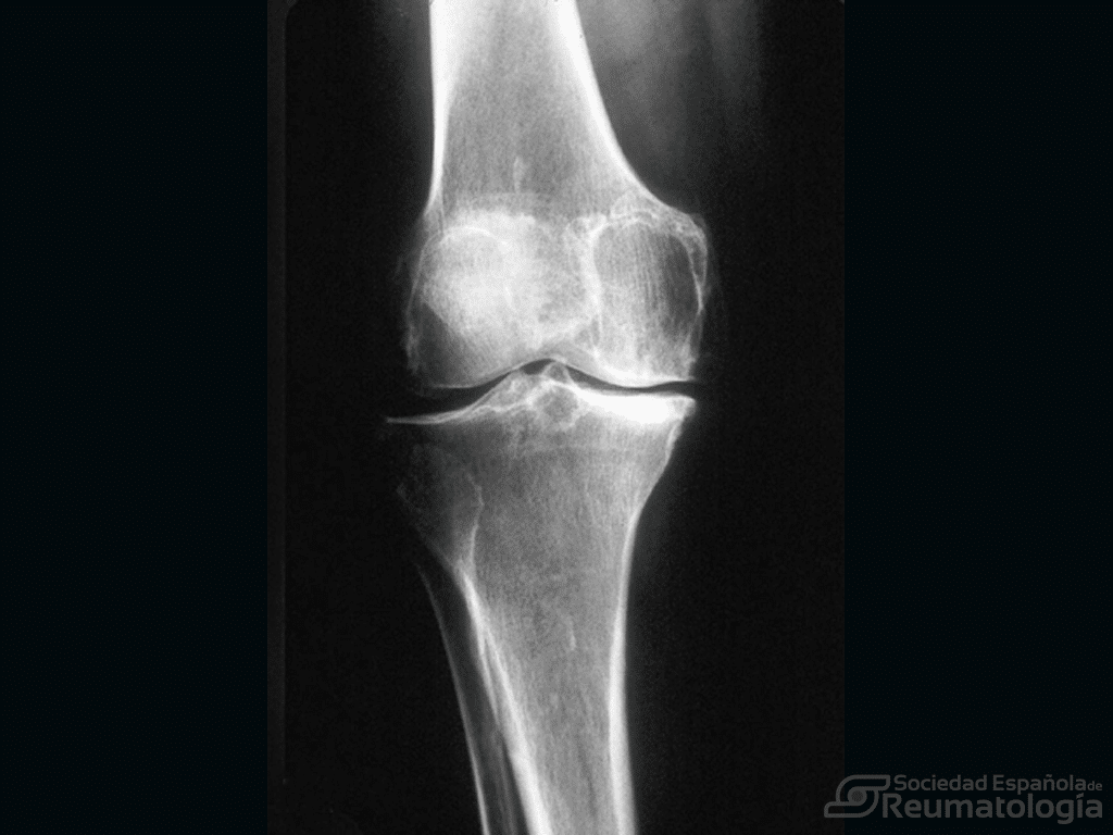 Artrosis de rodilla (Gonartrosis) • Dr. López Capapé