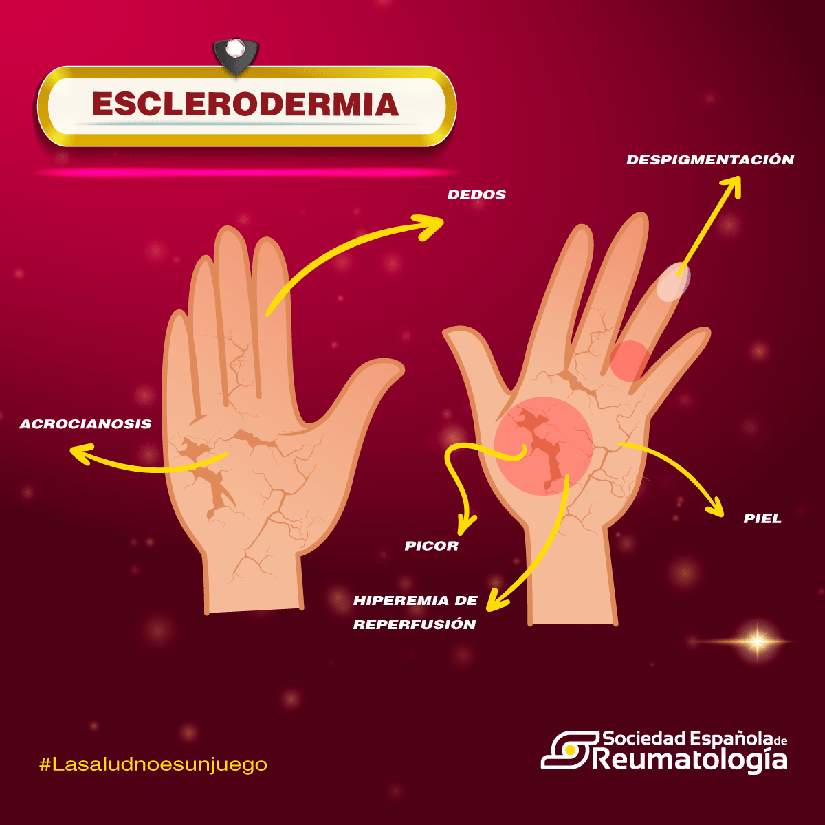 ESCLERODERMIA-AF