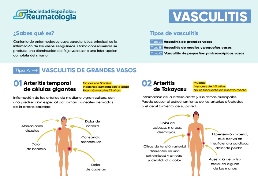 Vasculitis qué es síntomas diagnóstico y tratamiento