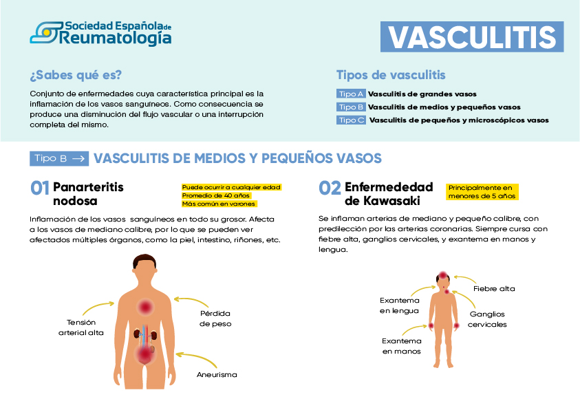 Vasculitis: es, síntomas, diagnóstico tratamiento