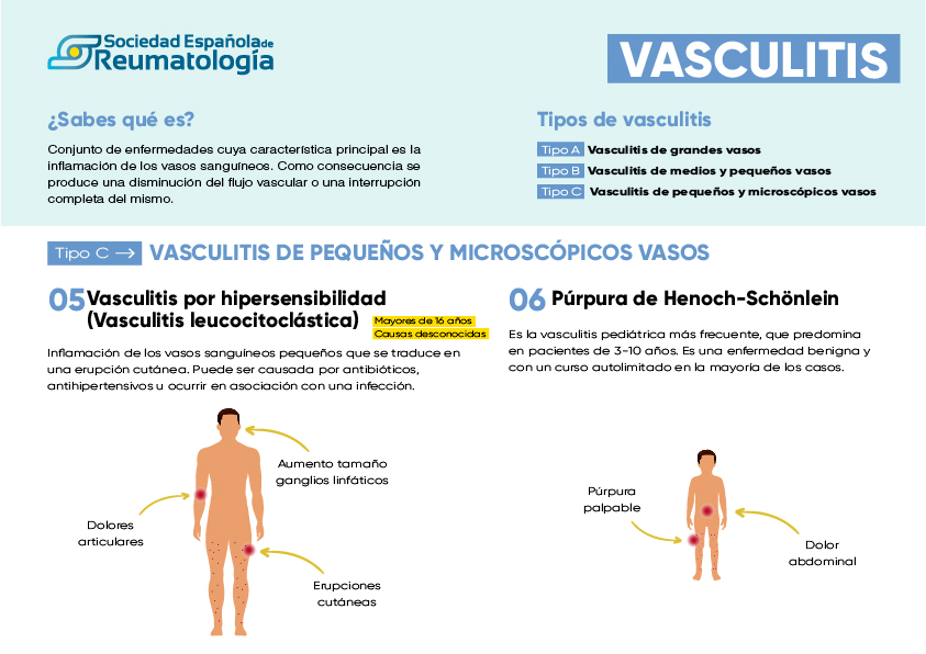 Vasculitis Qu Es S Ntomas Diagn Stico Y Tratamiento