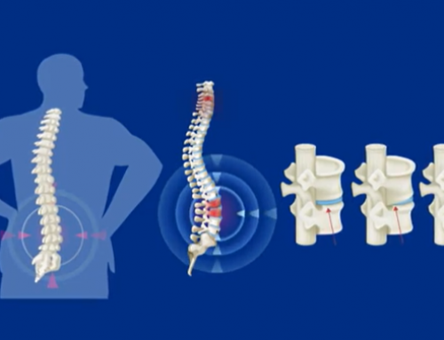 La espondiloartritis avanza hacia una medicina personalizada con un enfoque de género