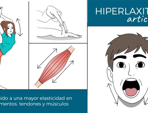 Hiperlaxitud articular: cuando ser más flexible que la media se convierte en un problema